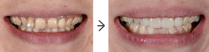 前歯部 オールセラミックの症例