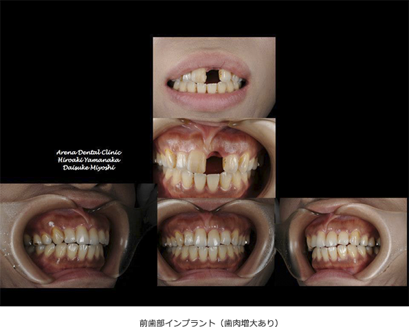 前歯部インプラントの症例